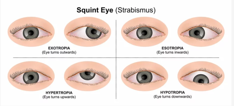 Best Squint Surgery Doctor in Chembur